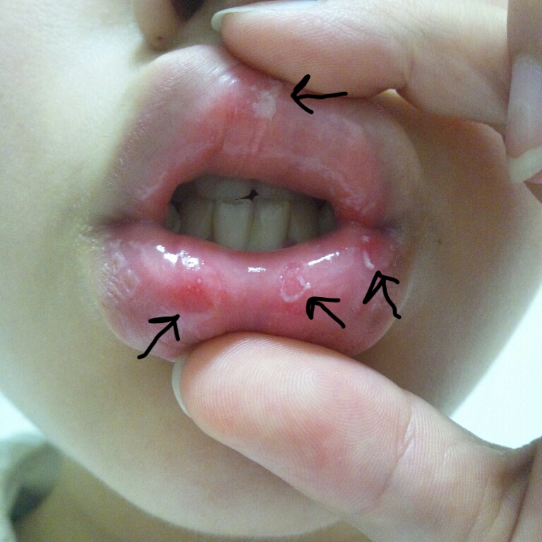 写真あり 唇の裏の皮が白く剥け 舌先のぶつぶつも剥がれてきた 歯チャンネル歯科相談室