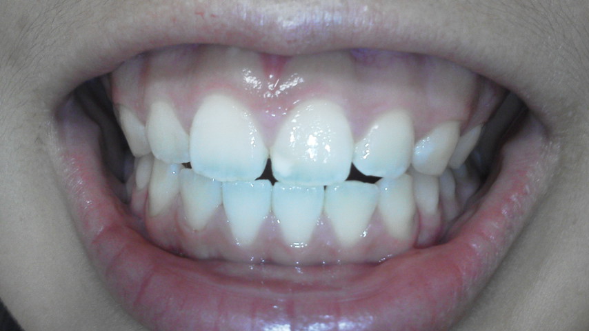 写真あり １３歳 ここ数日で急激に歯茎が下がって不安です 歯チャンネル歯科相談室