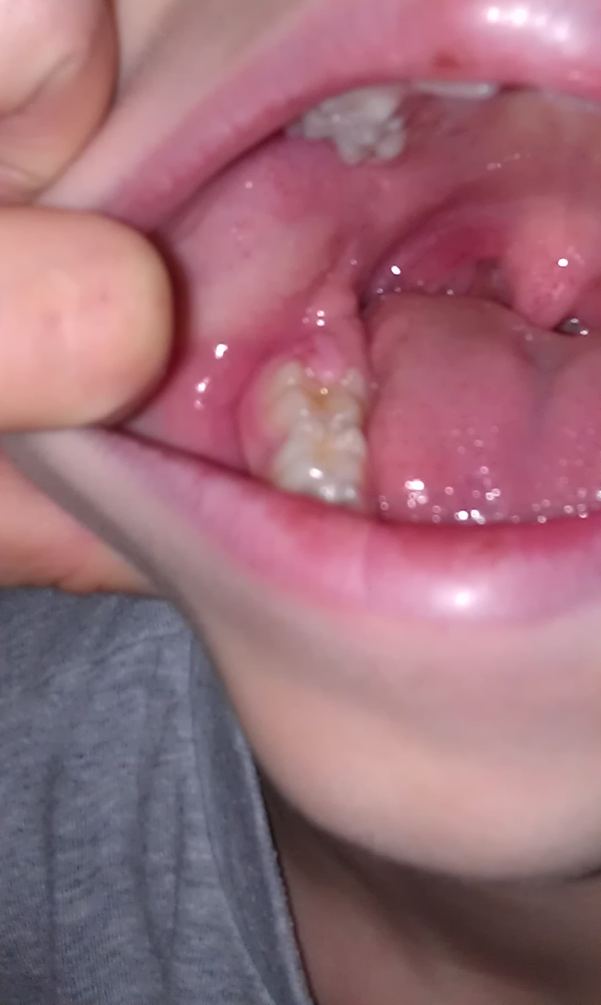 [写真あり] 7歳、歯茎からの出血があるが白血病でしょうか？ （海外） 歯チャンネル歯科相談室