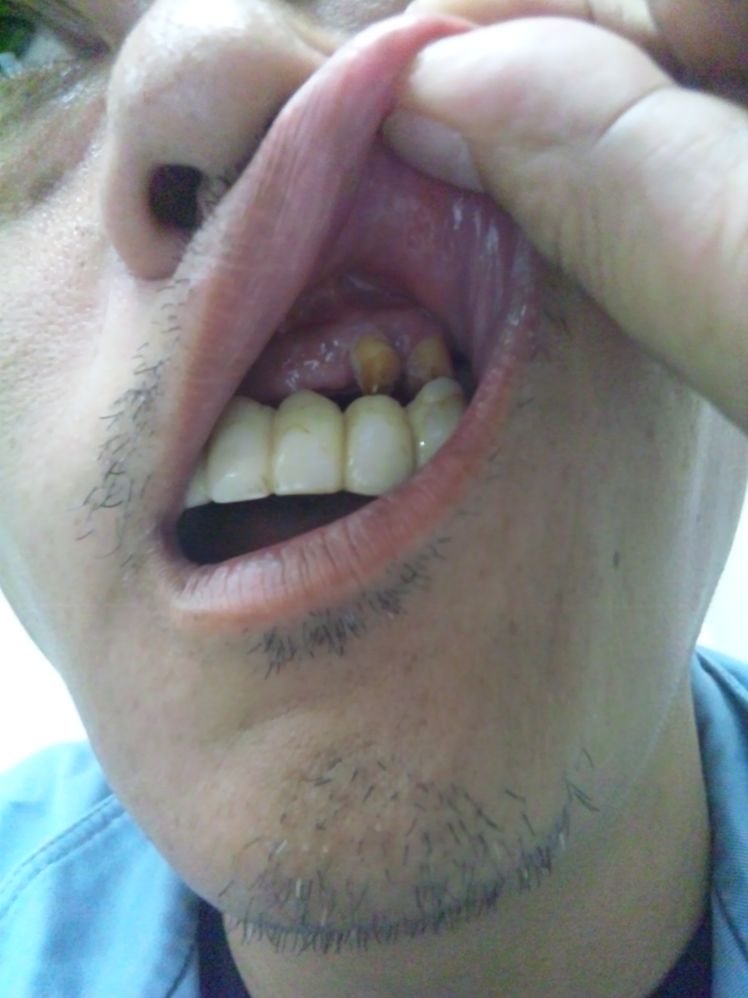 写真あり 前歯２本欠損 ６本ブリッジの支台歯がグラグラする 歯チャンネル歯科相談室