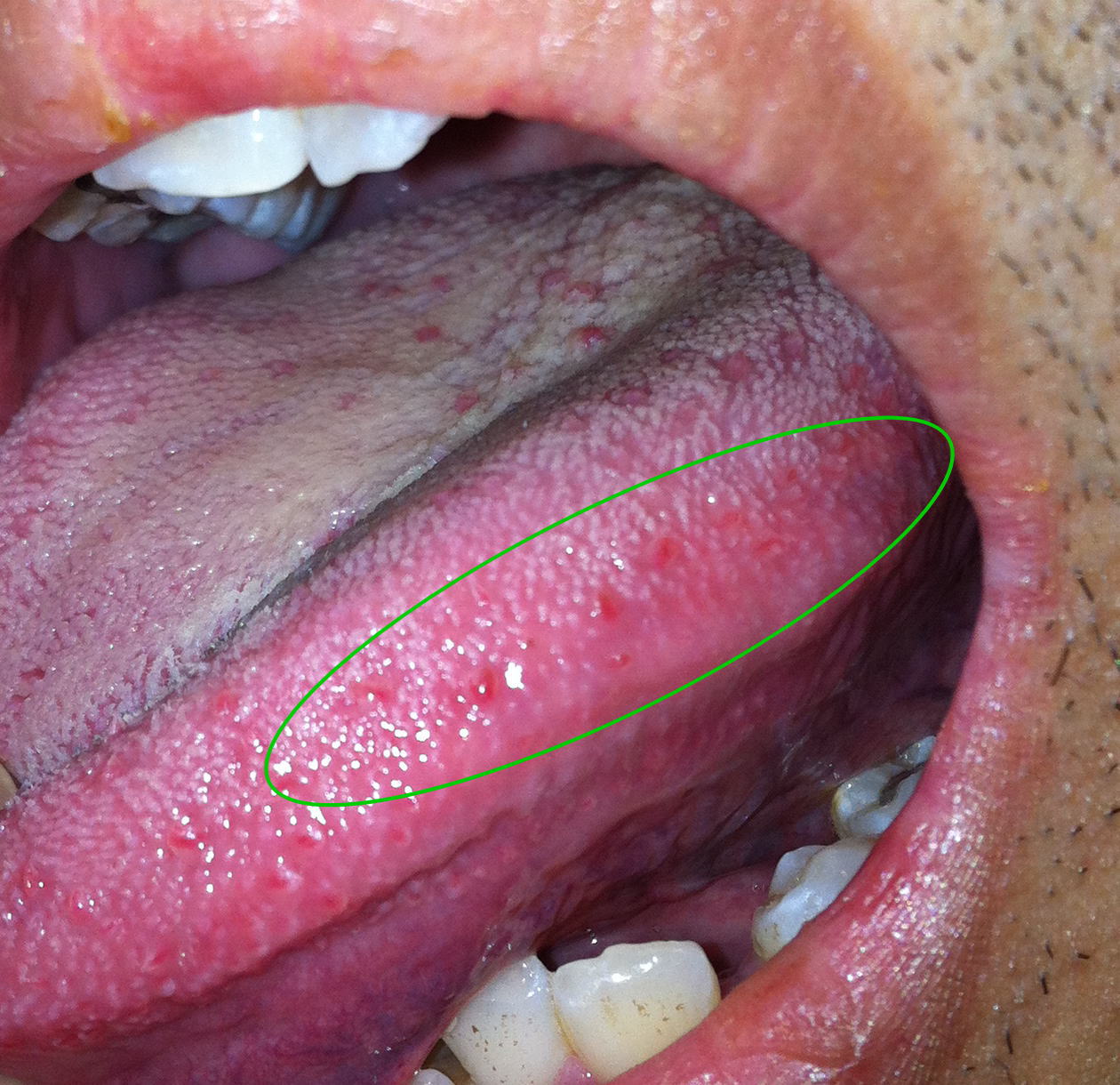 写真あり 舌側面に赤いブツブツが数個ありました 何なのでしょうか 歯チャンネル歯科相談室