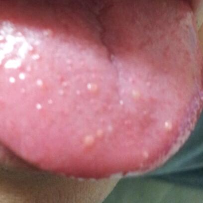 写真あり 舌が痛み赤い斑点と白い斑点がある 歯チャンネル歯科相談室