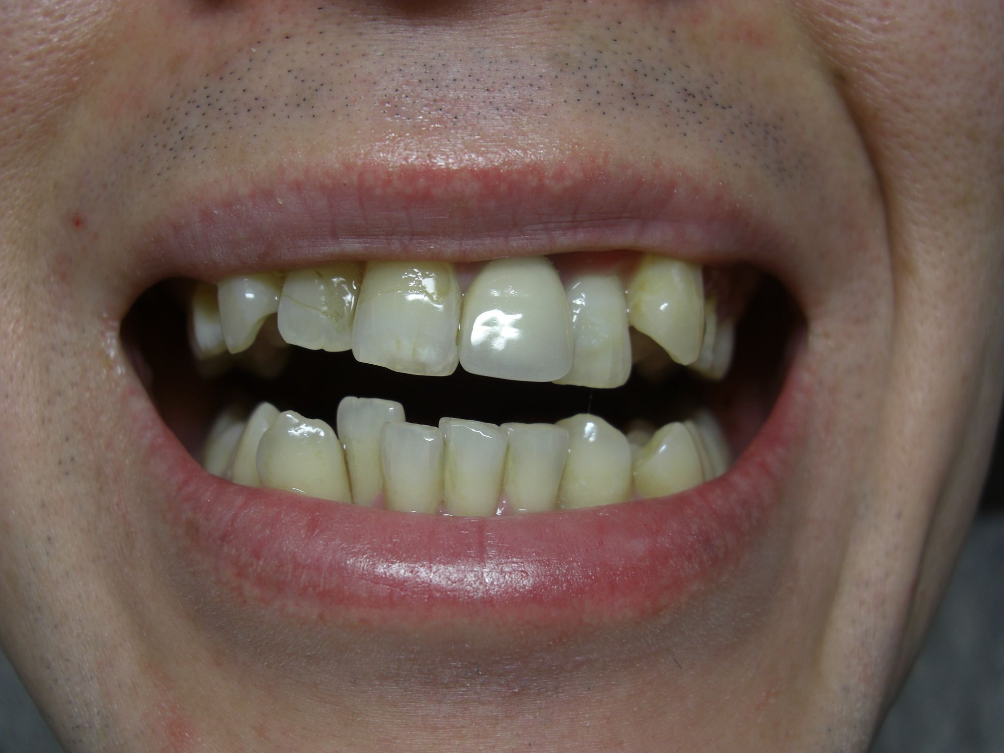 写真あり 下の左前歯 一本へこんでいる歯が気になります 歯チャンネル歯科相談室