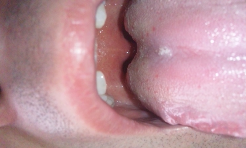 写真あり 舌の中央に白いブツブツが出来たが 可能性のある病気は 歯チャンネル歯科相談室