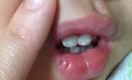 写真あり 1歳8ヶ月 歯の白濁したシミについて 歯チャンネル歯科相談室