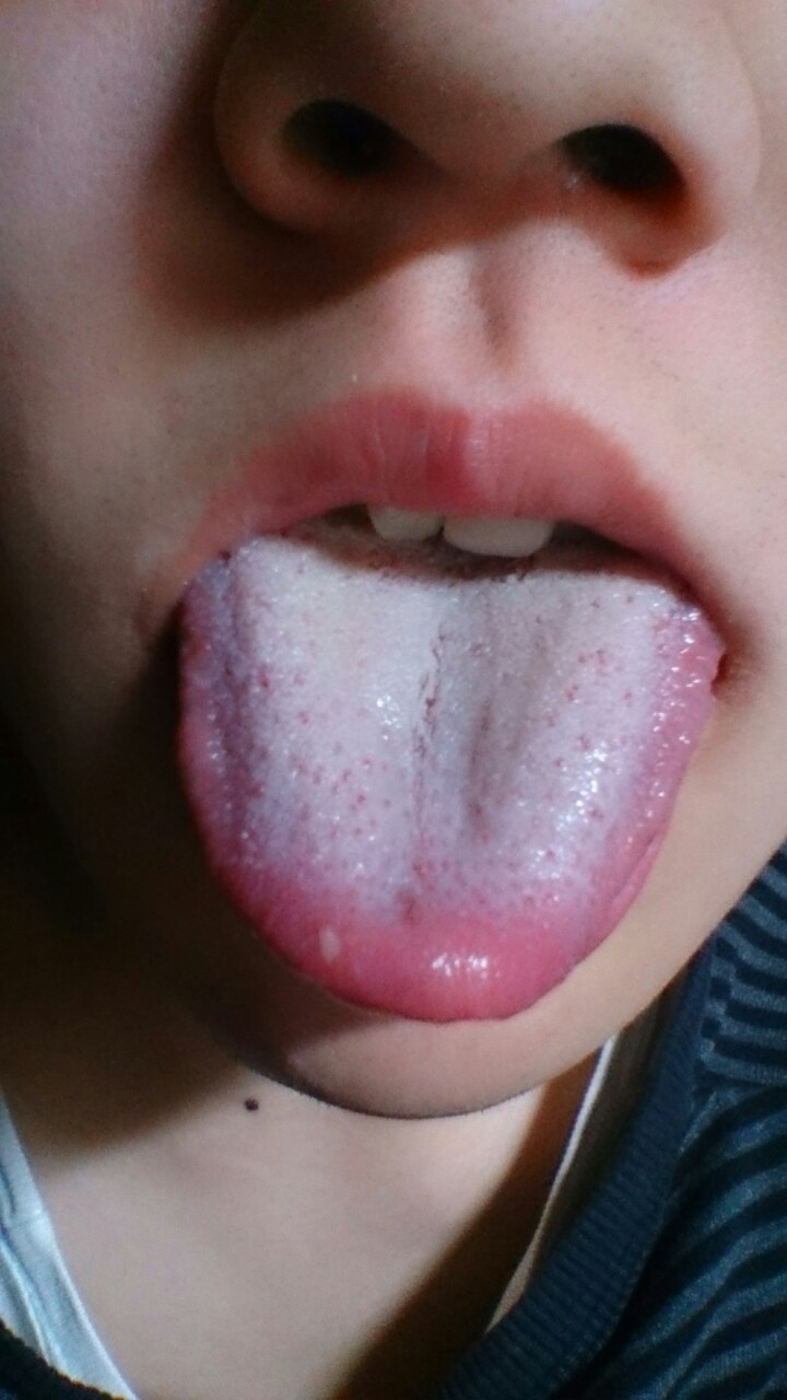 癌 症状 舌 初期