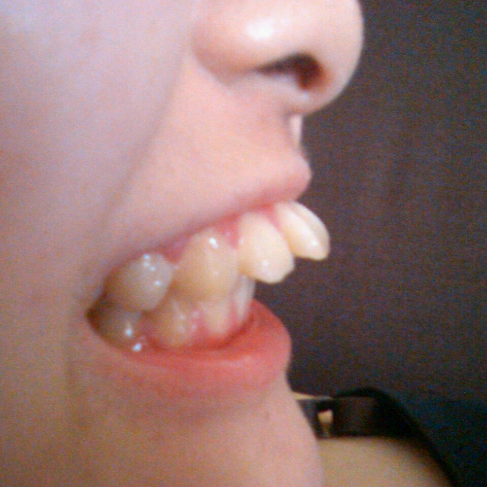 写真あり 出っ歯のため 前歯4本を差し歯にしたい 歯チャンネル歯科相談室