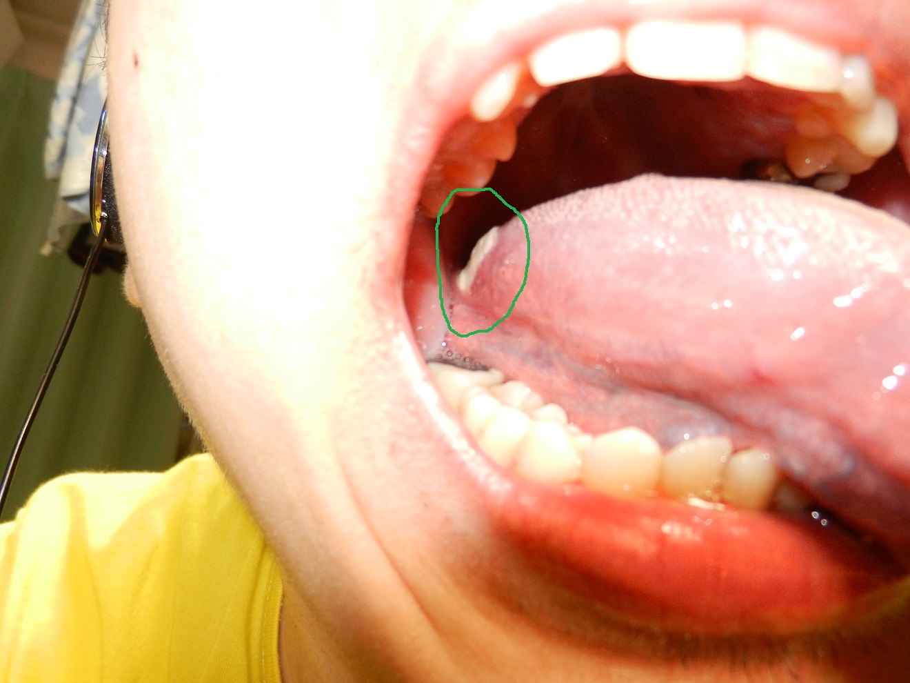 写真あり 舌の側面にある白い苔のようなできものについて 歯チャンネル歯科相談室