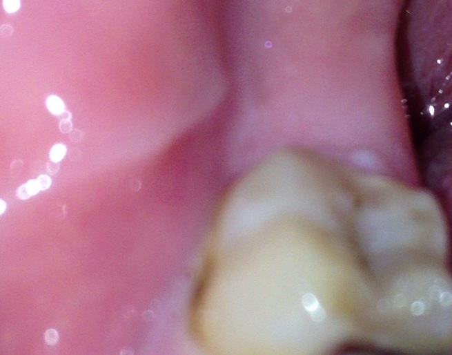 写真あり 歯の側面に茶色の線ができた 歯チャンネル歯科相談室
