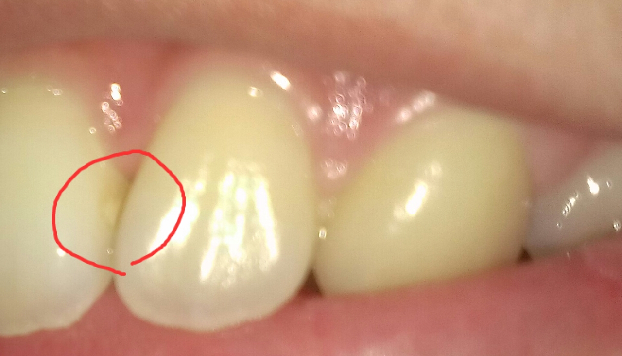 写真あり 前歯の白い虫歯を削る必要はあるのか 歯チャンネル歯科相談室