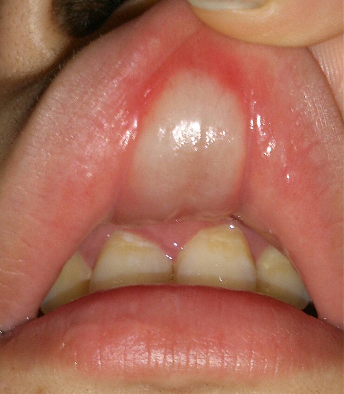 写真あり 虫歯治療のため麻酔後 唇の裏が白く腫れ上がっていました 歯チャンネル歯科相談室