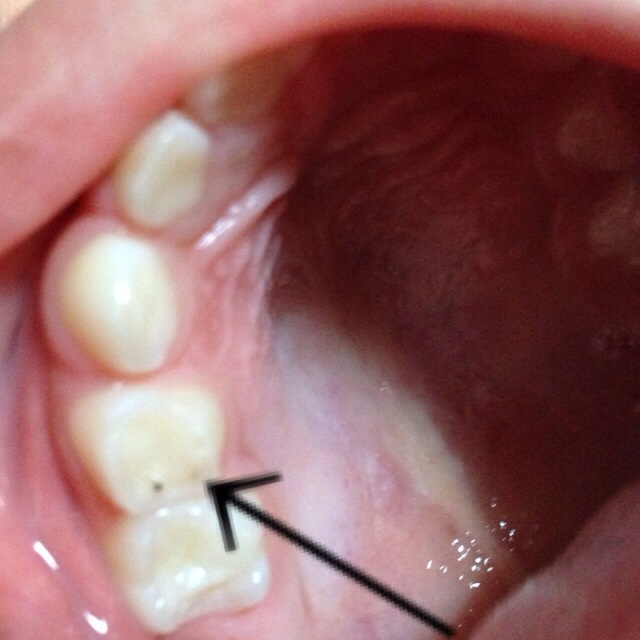 写真あり ４歳７ヶ月 歯に黒い点を発見しました 歯チャンネル歯科相談室