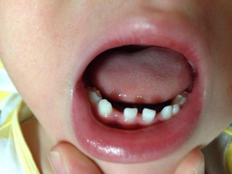 [写真あり] 1才9ヶ月、下顎b.cの生え方について