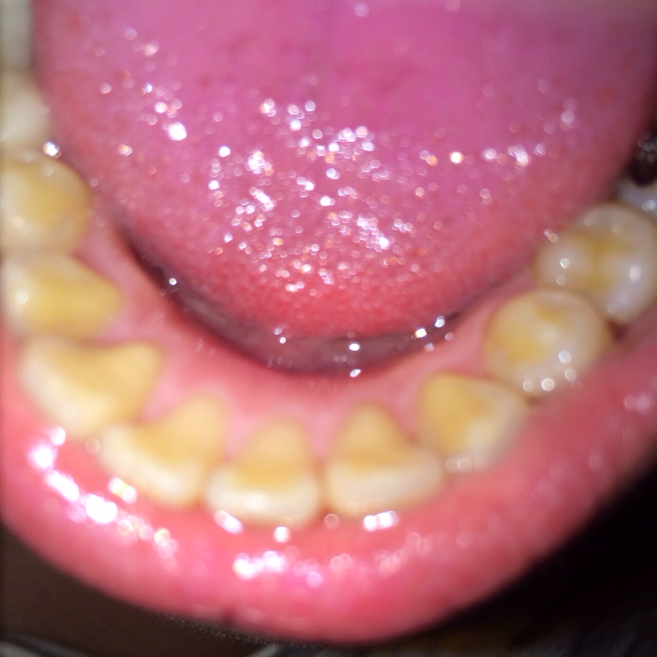 写真あり 歯の溝や裏が黄色い 虫歯でしょうか 歯チャンネル歯科相談室