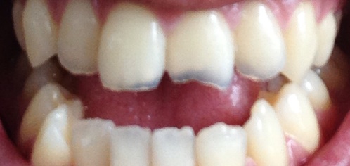 写真あり 嘔吐癖で溶けた前歯の修復はできますか 歯チャンネル歯科相談室