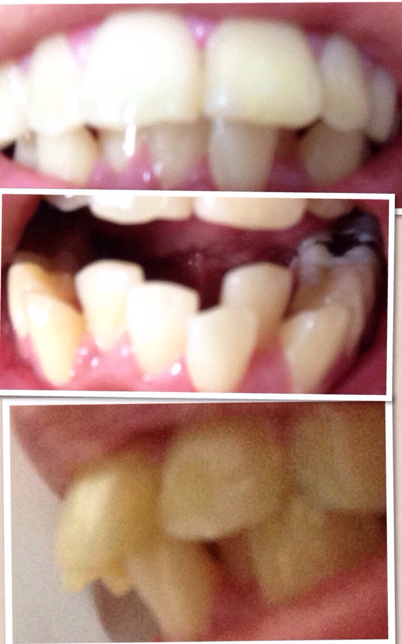 写真あり 上は出っ歯で下はガタガタ マウスピース矯正は可能か 歯チャンネル歯科相談室