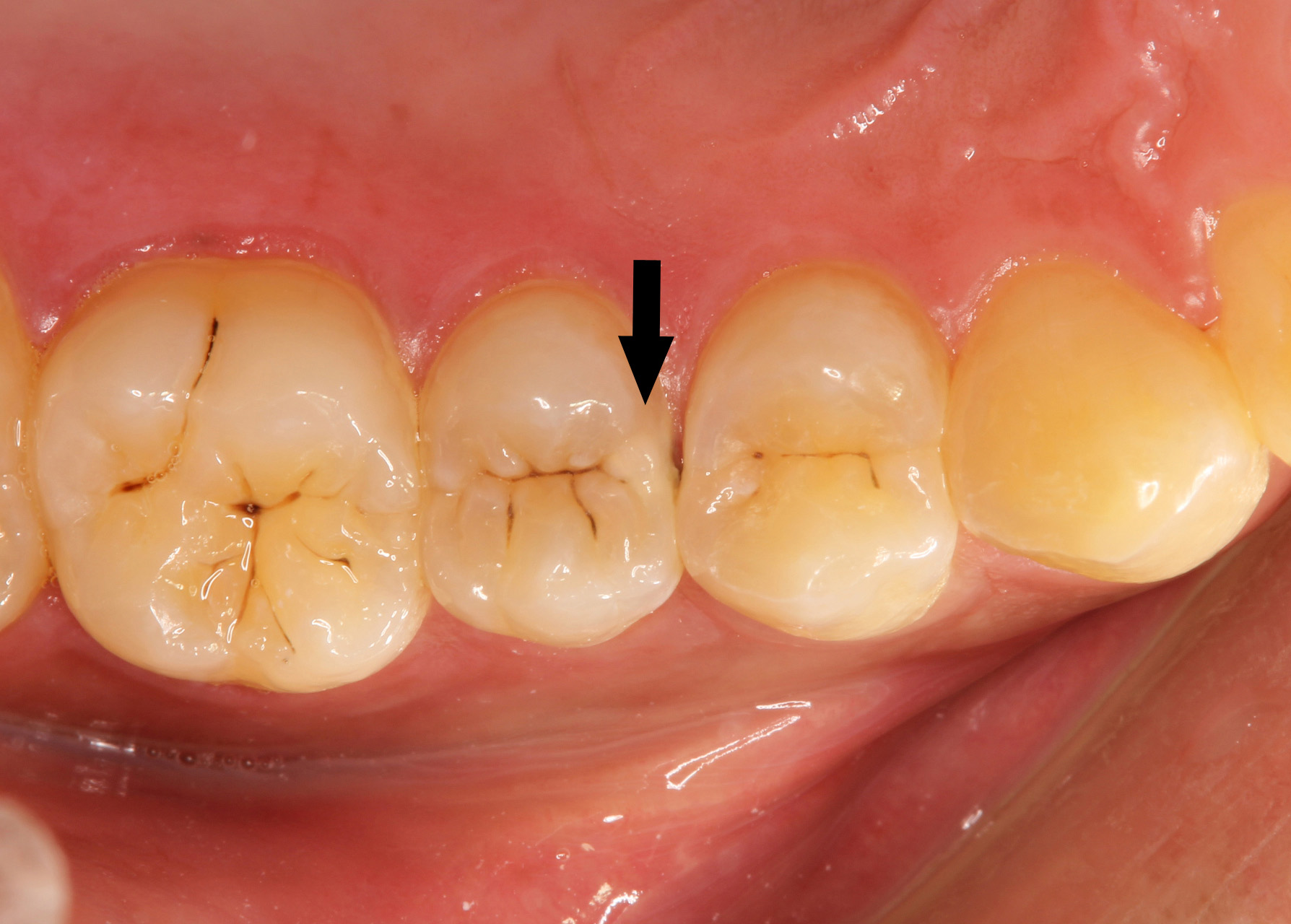 歯 と 歯 の 間 虫歯