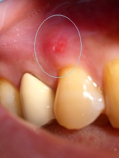 噛む 固い 歯 痛い もの が と を 噛むと歯が痛い！その原因はこの４つ！