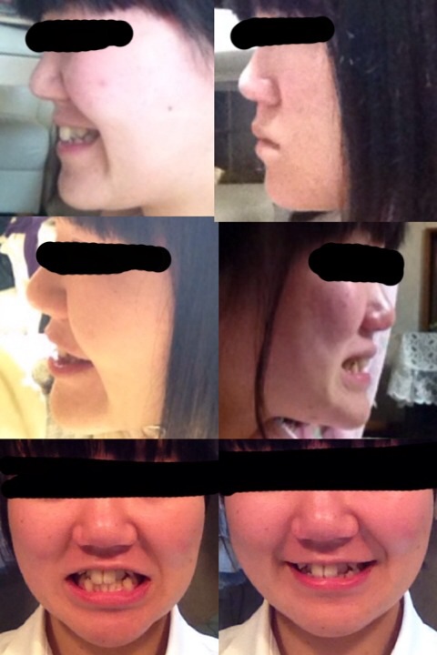 写真あり 頬骨や目等の顔の歪みは顎変形症と関係ありますか 歯チャンネル歯科相談室