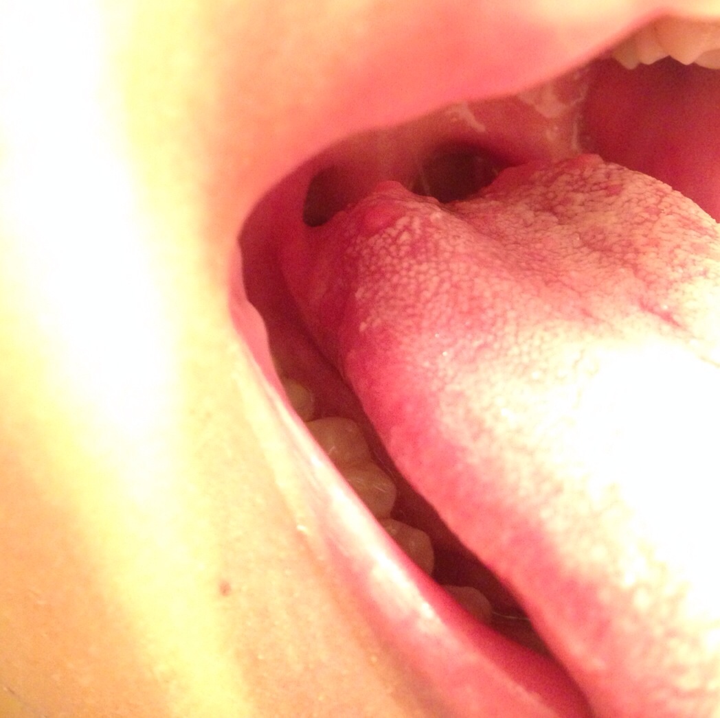の もの でき 喉 赤い 奥 口からでてくる臭い玉（膿栓）の原因や改善法を紹介！口臭にも関係あるって本当？