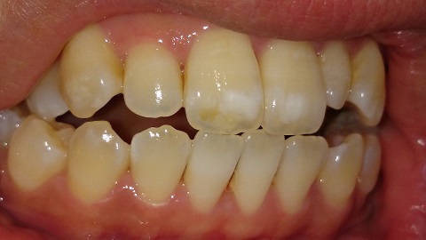 写真あり 歯茎が下がりが気になる 過食嘔吐あり 歯チャンネル歯科相談室