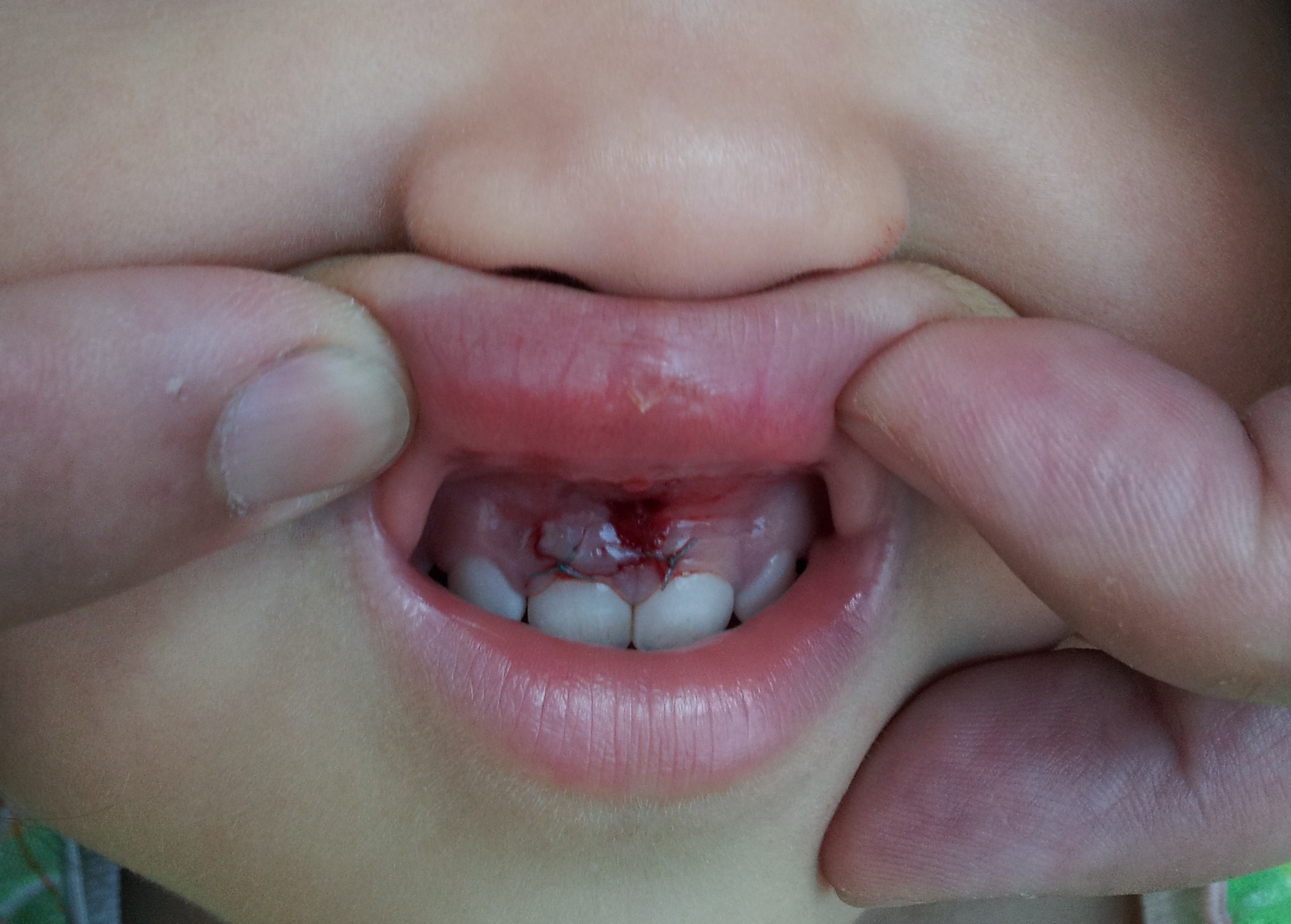 写真あり ２歳半 転倒し前歯をぶつけ歯茎を縫合 上海 歯チャンネル歯科相談室