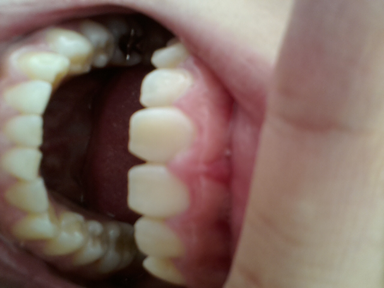 写真あり 過食嘔吐の歯 酸蝕歯でしょうか 歯チャンネル歯科相談室