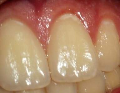 写真あり 前歯の白い斑点がしみる 治療方法 費用を知りたい 歯チャンネル歯科相談室