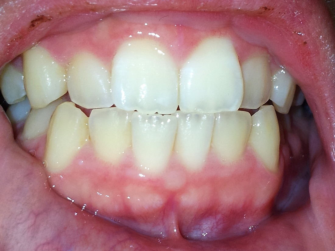 歯 見える から 歯茎 が インプラントと歯茎の間に金属が見える。抜けるのでしょうか？