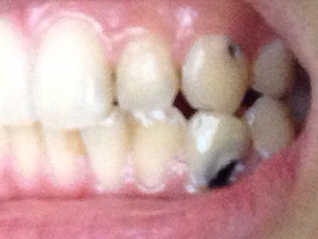 １６歳 放置した虫歯が痛み治療したい 歯チャンネル歯科相談室