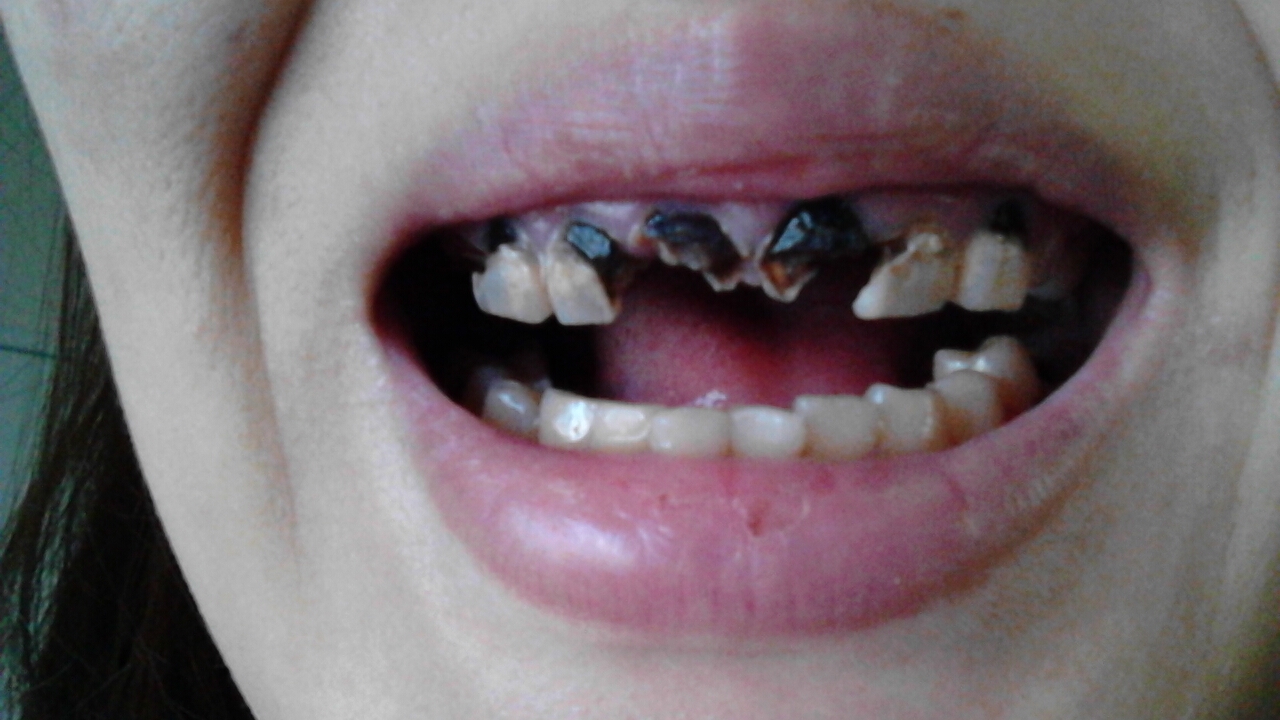 [写真あり] 15年虫歯を放置しひどい状態に、治すことはできますか？ 歯チャンネル歯科相談室