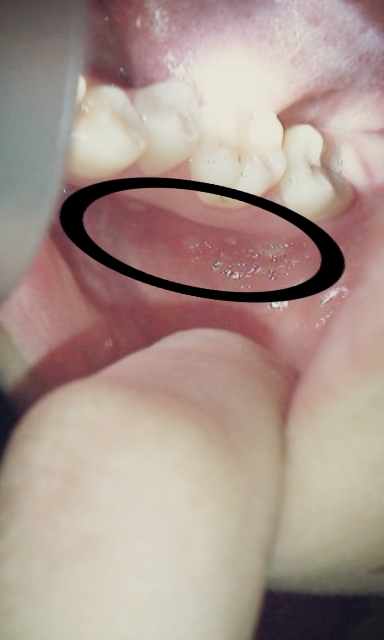 写真あり ４ ５日前から急に右下奥歯の頬側の歯茎が痛い 歯チャンネル歯科相談室