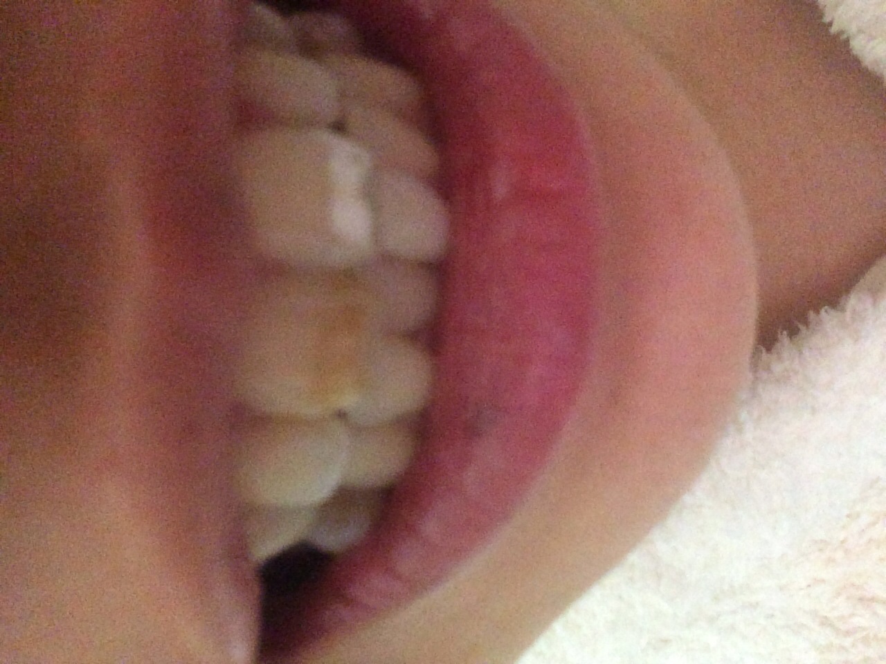 [写真あり] 自分で削ってしまい歯が変色してしまいました 歯チャンネル歯科相談室