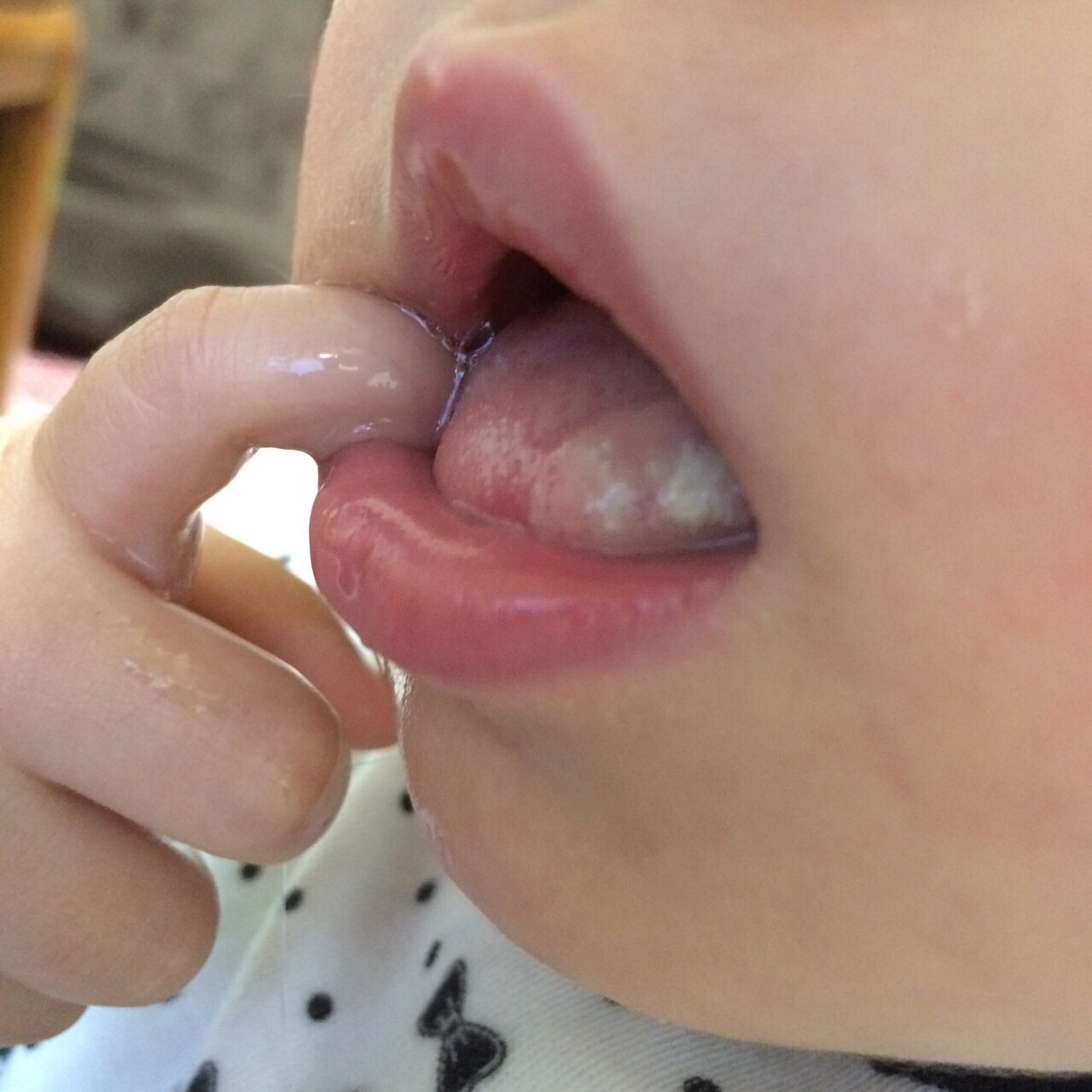 写真あり １才半 舌が白く腫れている ｒｓ罹患中 歯チャンネル歯科相談室
