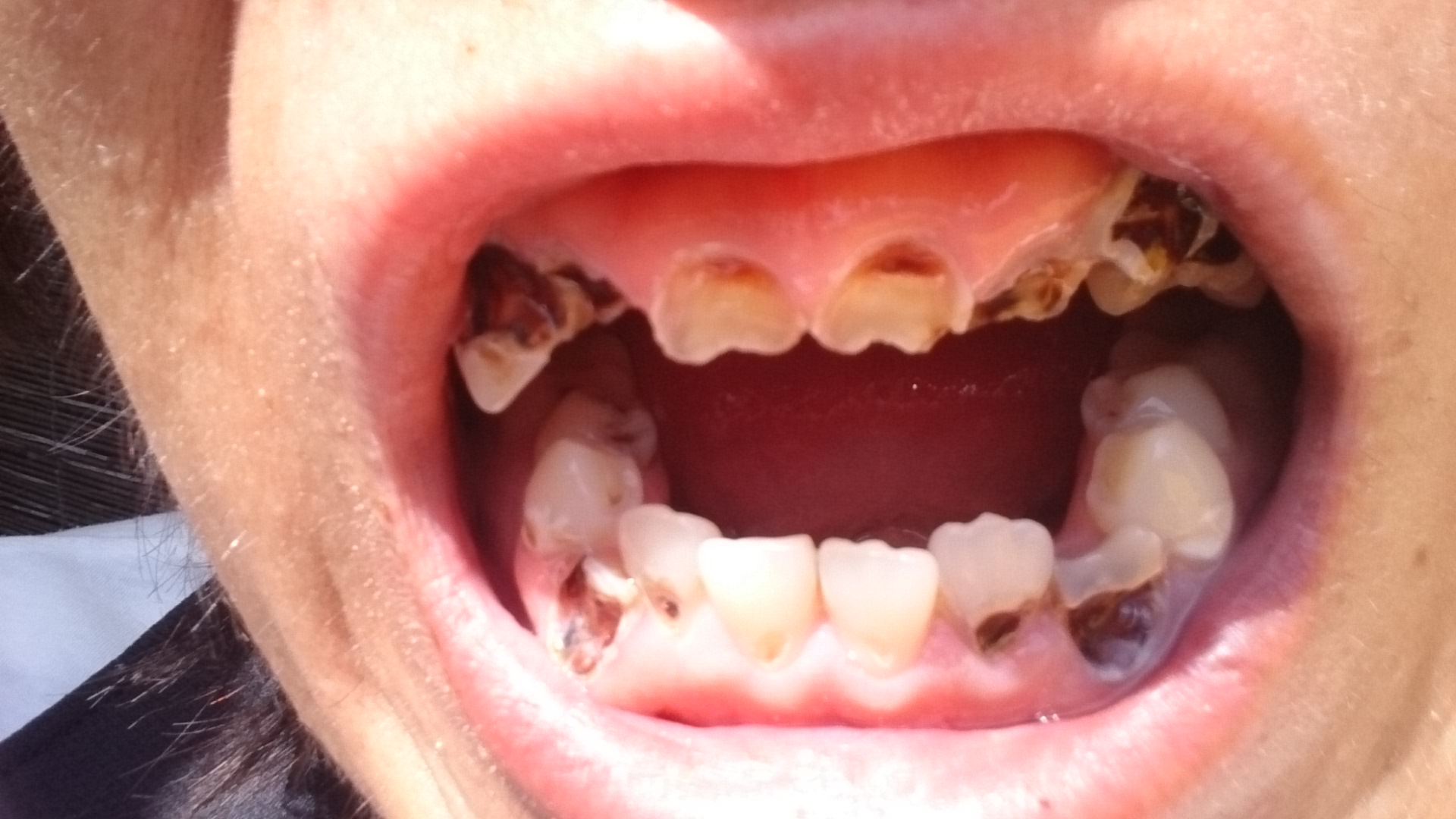 写真あり 虫歯で見た目がひどい 歯チャンネル歯科相談室
