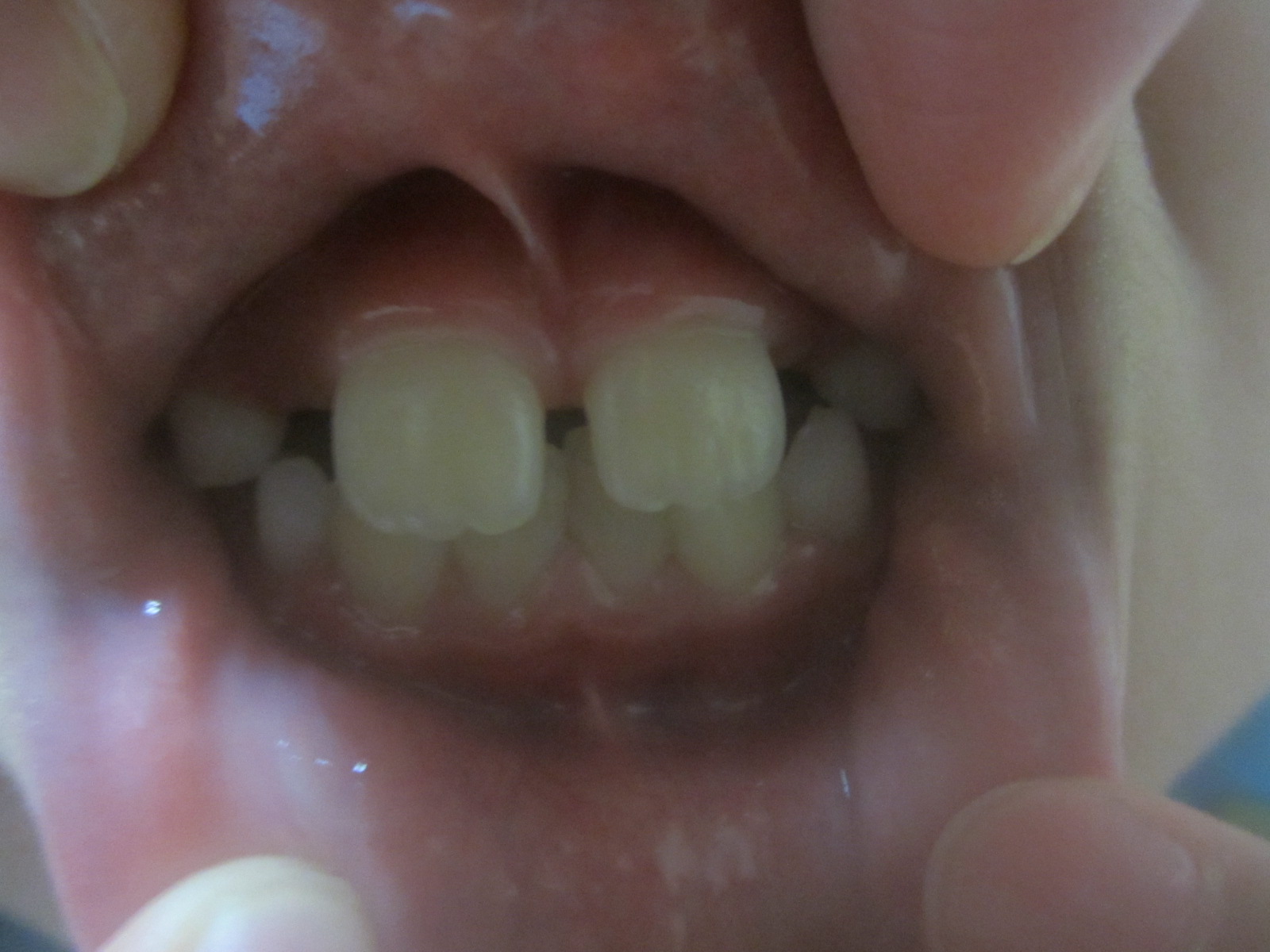 [写真あり] 8歳児。 上唇小帯切除と矯正の時期で悩む 歯チャンネル歯科相談室