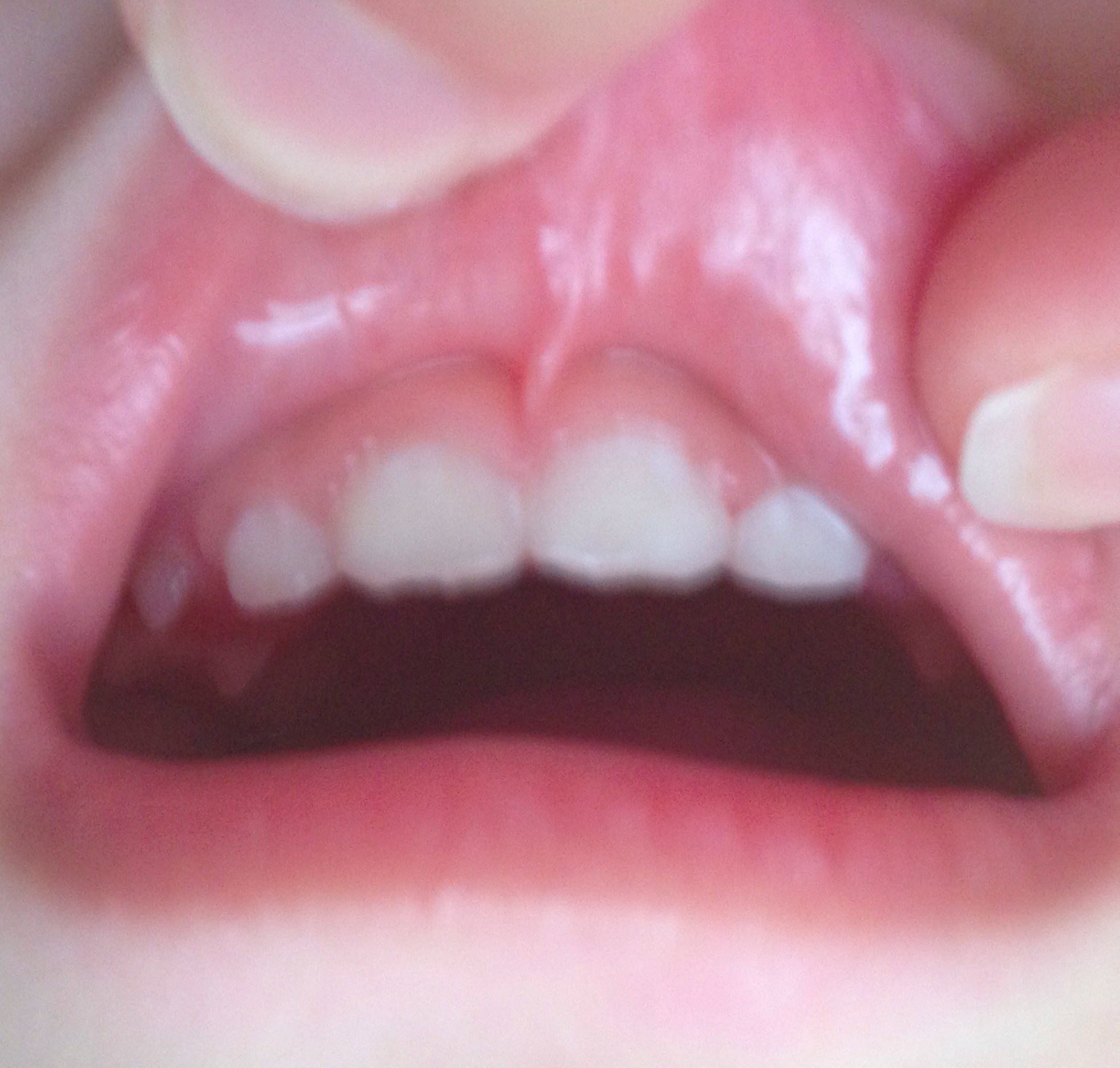 写真あり １歳９ヶ月 前歯が白いのは初期虫歯でしょうか 歯チャンネル歯科相談室
