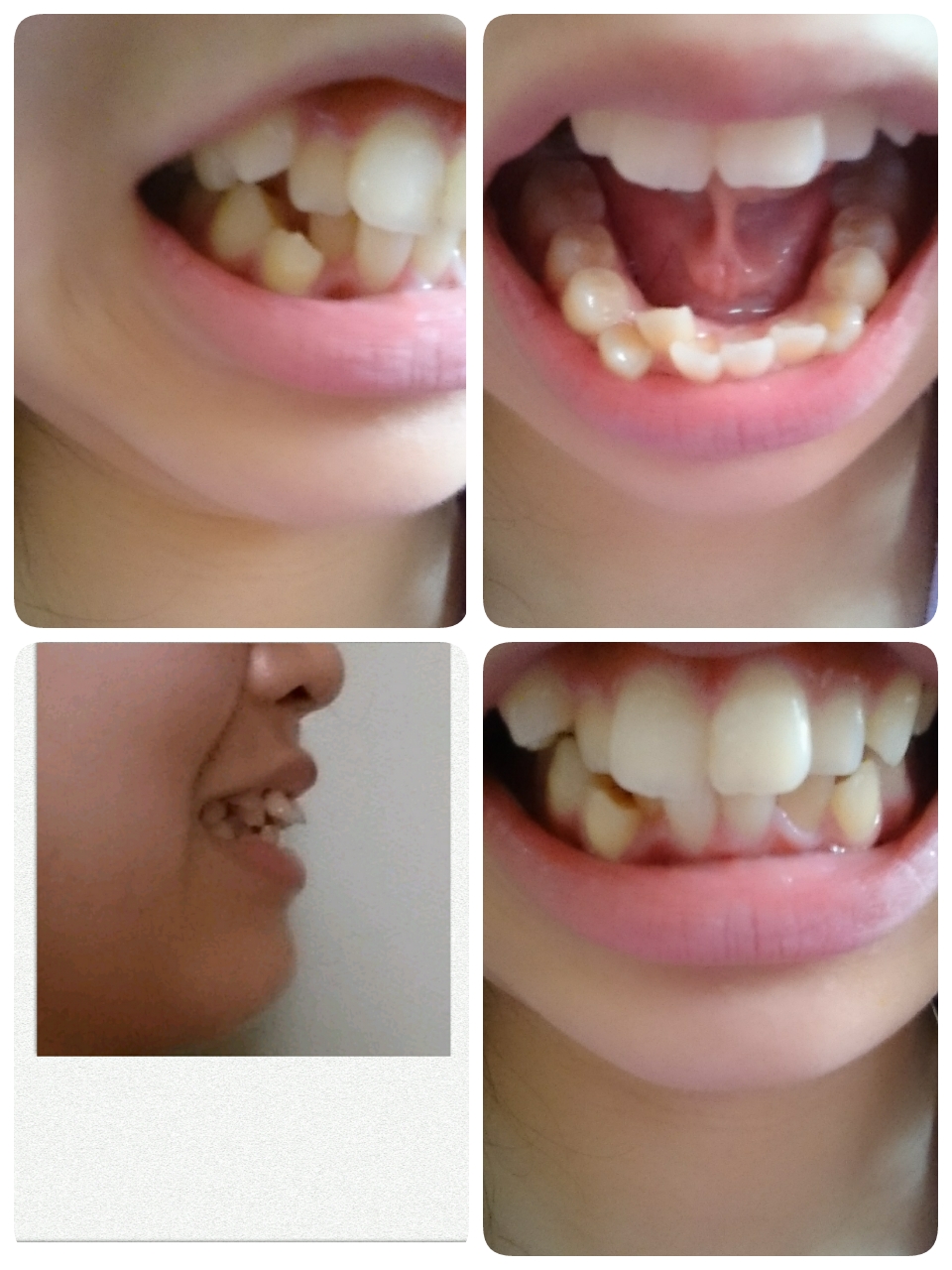 写真あり 前歯と八重歯の歯列矯正について 歯チャンネル歯科相談室