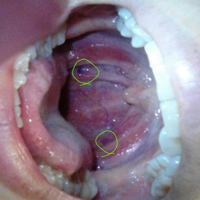 写真あり 口内奥の両側に血豆のようなもの 歯チャンネル歯科相談室