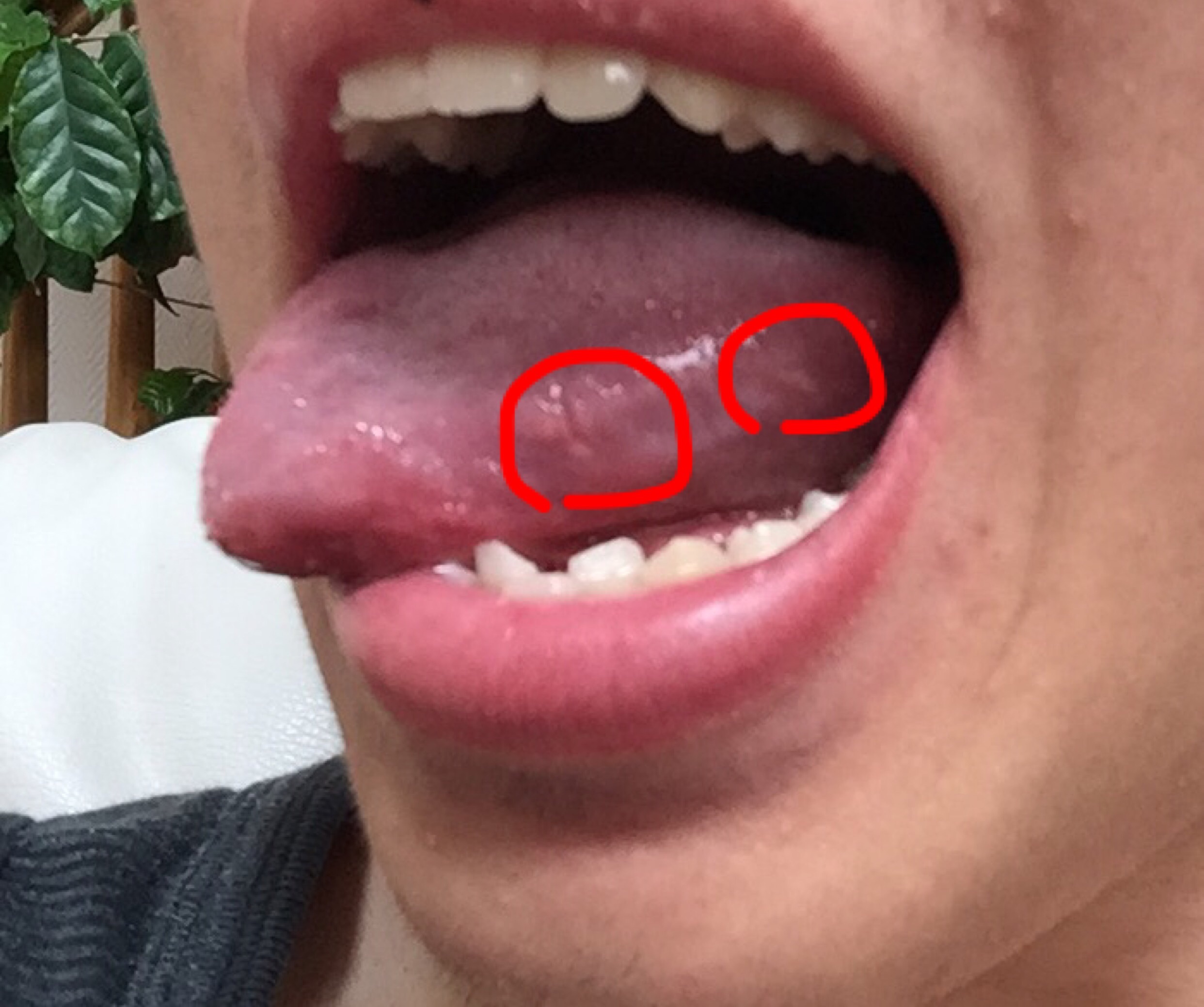 写真あり 舌の側面が白い 舌癌ではないか とても不安です 歯チャンネル歯科相談室