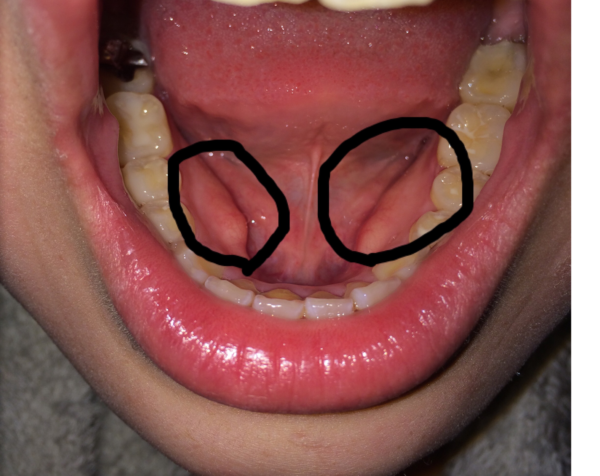 口 の 内側 腫れる