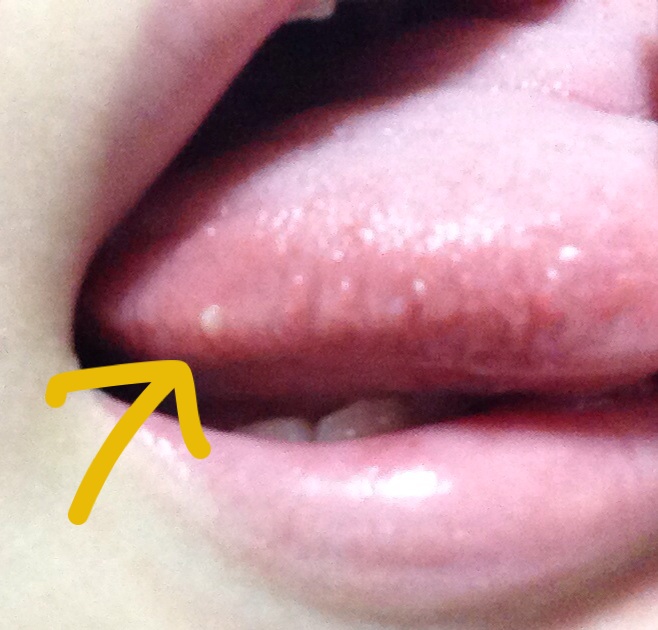 写真あり 舌の側面の硬くて白い突起物が痛い 臨月 歯チャンネル歯科相談室