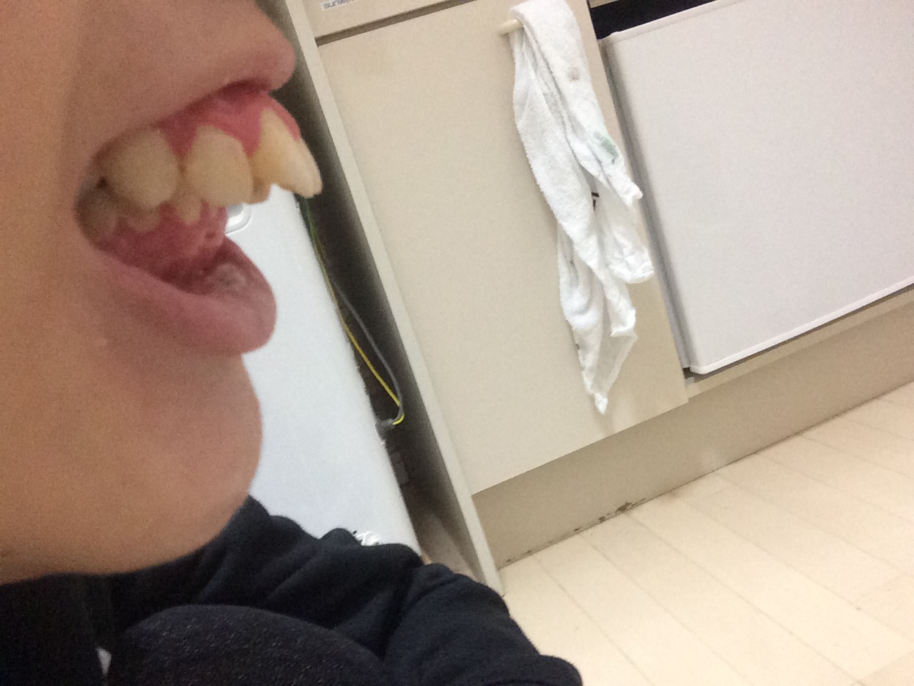 写真あり かなりの出っ歯を治療したい 歯チャンネル歯科相談室