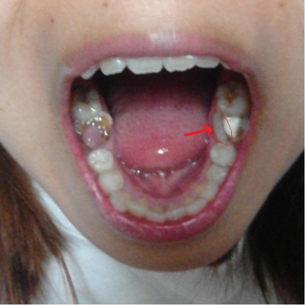 写真あり 被せ物が取れたまま放置していたら酷い虫歯に 歯チャンネル歯科相談室