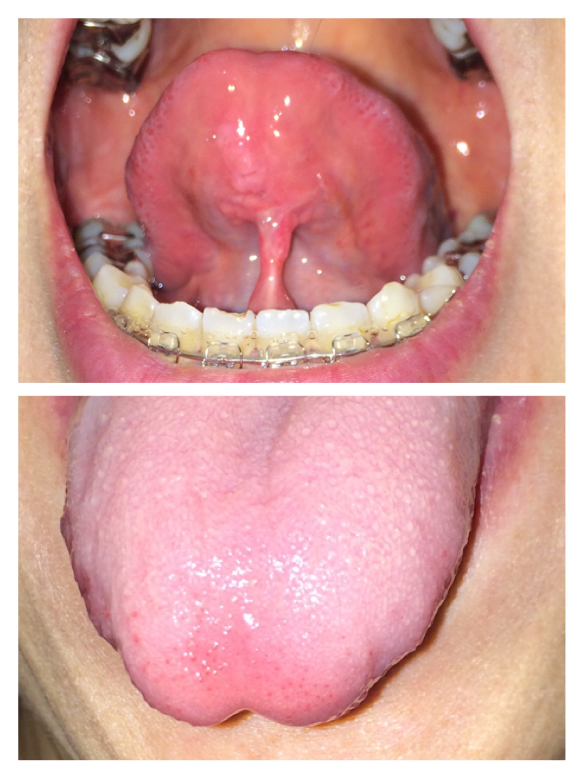 写真あり 一週間前に舌小帯切除 術前よりも短くなったように感じがする 歯チャンネル歯科相談室