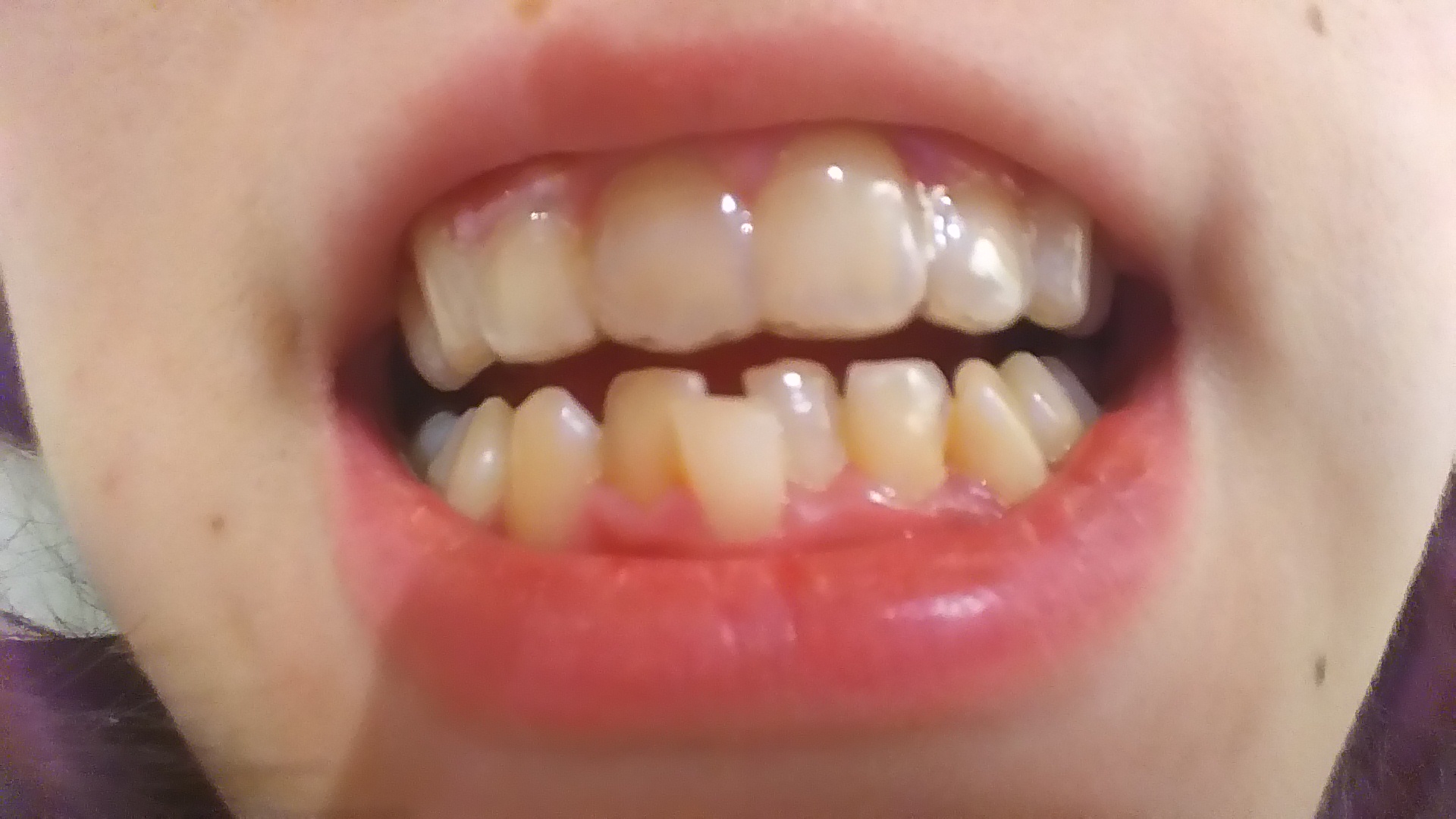 [写真あり] 上前歯の保定中に下前歯を矯正したい 歯チャンネル歯科相談室