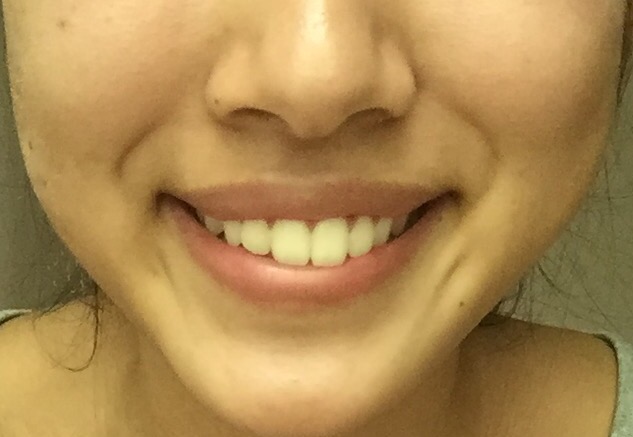 写真あり 笑う時に口角の高さが違うのは顎変形症だから 米国 歯チャンネル歯科相談室