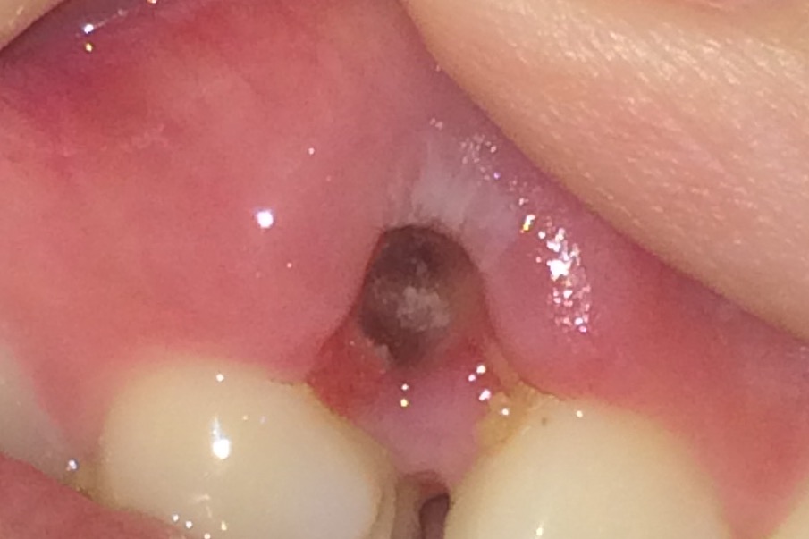 穴 食べかす 後 抜歯 歯を抜いた後の穴はどう治癒していくの？