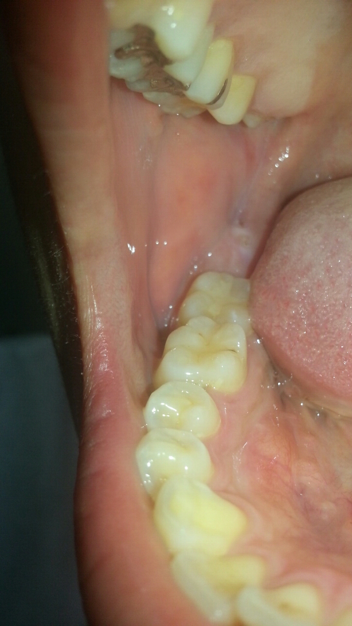 写真あり 口内炎だと思って放置したら黒い穴の様なものが出来ました 歯チャンネル歯科相談室