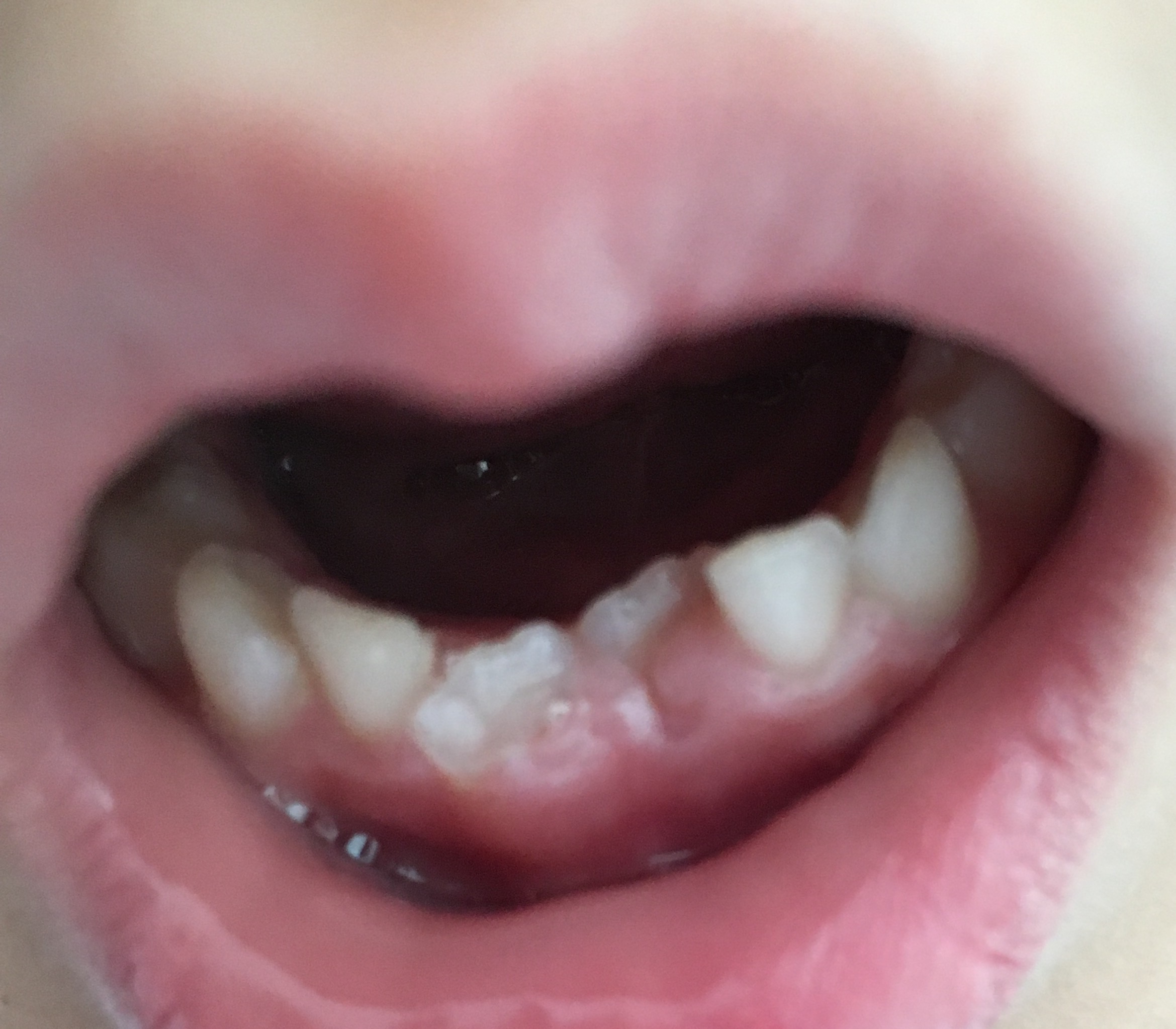 写真あり ６歳 下前歯の永久歯が斜めに生えてきている 海外 歯チャンネル歯科相談室